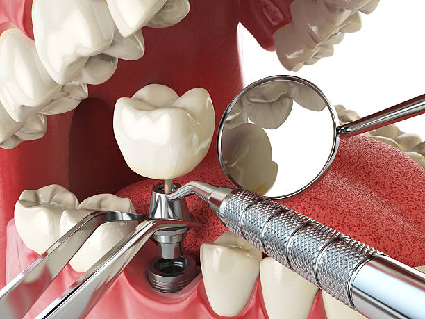 Best Emergency Root Canal Treatment in Springfield, GA